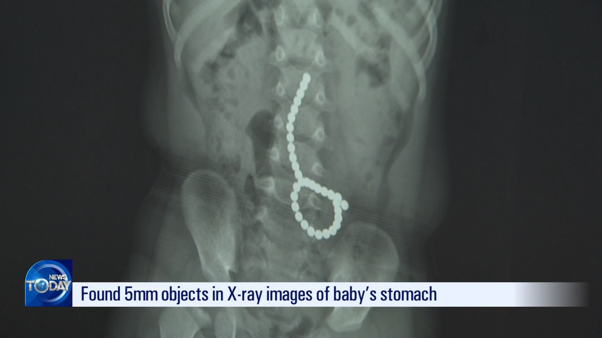 [News Today] Baby swallows 33 magnetic beads