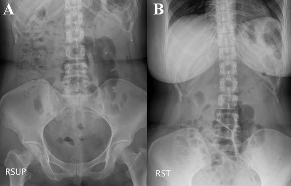 만성변비 환자의 복부 엑스레이 사진 (자료제공: 중앙대병원) 