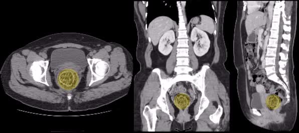 복부CT에서 4.7cm 크기 '대변덩이' 확인 (자료제공: 중앙대병원) 
