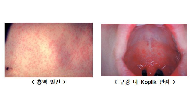 홍역 환자 지난해 1.4배↑…“유행국 방문 전 예방 접종해야”