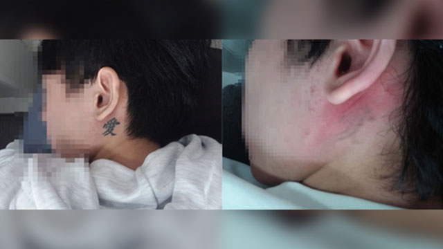 청소년 문신 지워준 ‘사랑의 지우개’…10년간 479명 시술