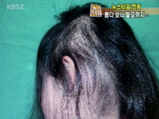 [뉴스타임 현장] 머리 뽑는 버릇 있다면…‘발모광’ 탈모 주의 