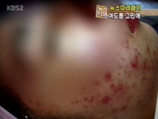 [뉴스따라잡기] 자살에 이르게한 ‘여드름 고민’ 